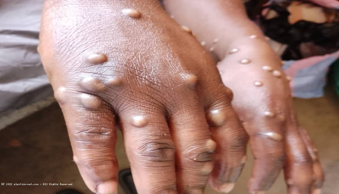 Sud-Kivu : plus de quatre-vingts cas de l'épidémie Monkeypox enregistrés en l'espace de trois mois