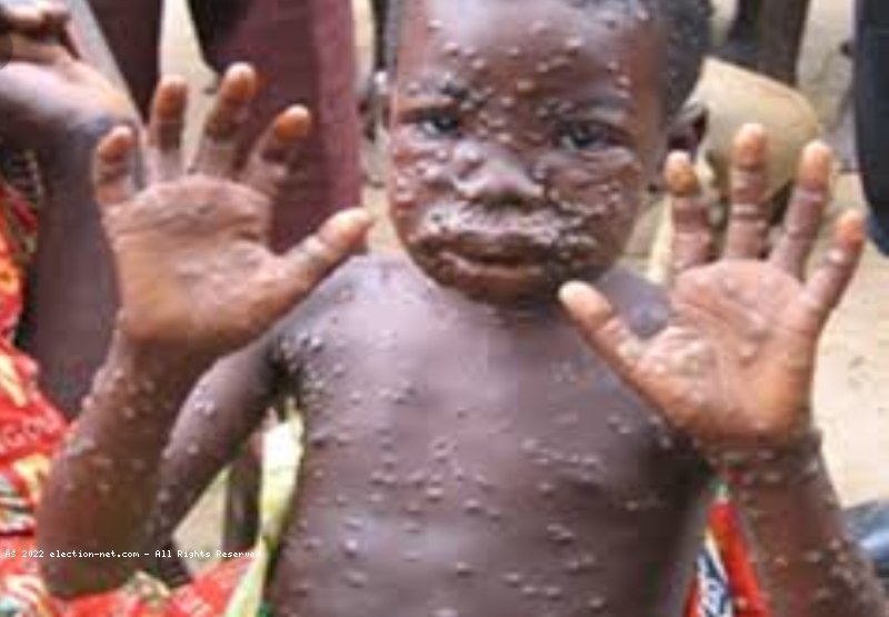 RDC : voici l'âge des personnes plus touchées par l'épidémie de Monkeypox
