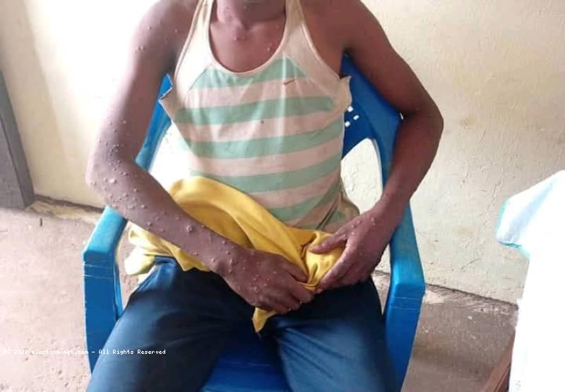 Kasaï-Central : trois cas de Monkeypox confirmés à Demba