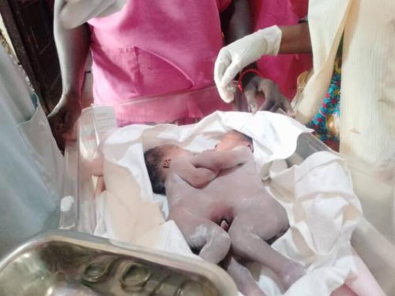 RDC : Deux bébés siamois transférés à Kinshasa